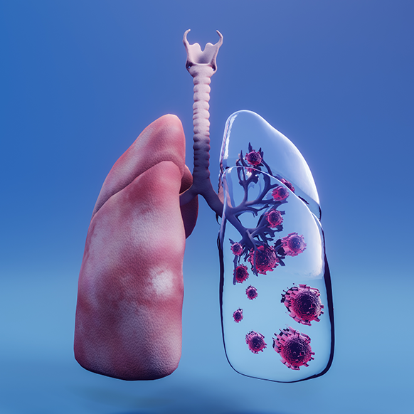 pulmones, sistema respiratorio, infecciones respiratorias